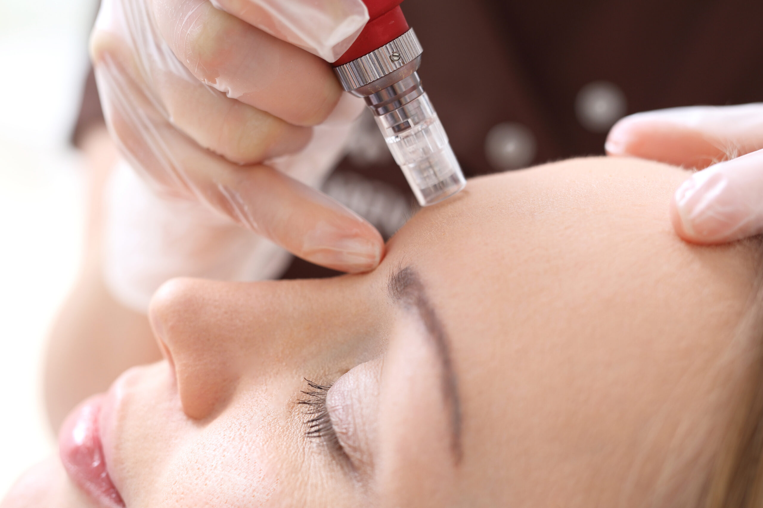 micro needling scaled